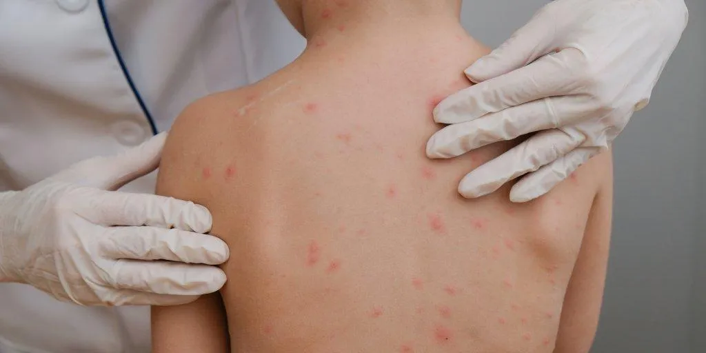 Zdjęcie Skuteczne leczenie liszajca zakaźnego - sposoby na szybkie pozbycie się zmian