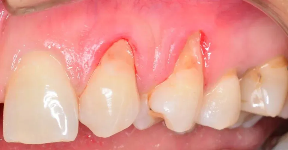 zaawansowana recesja dziąseł konsekwencje