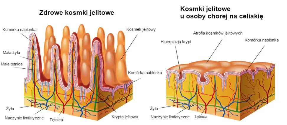 porównanie jelita zdrowego i jelita z celiakią