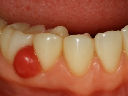 r&oacute;żne rodzaje ran na dziąsłach