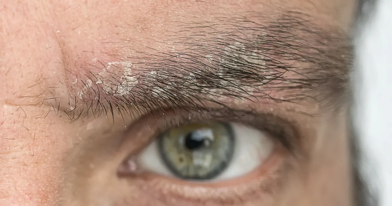 domowe sposoby na pryszcze między brwiami