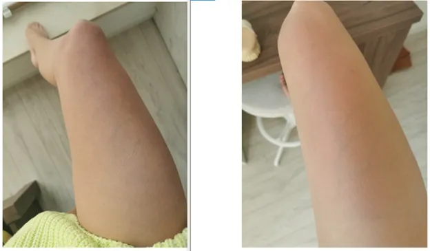 szczotkowanie na sucho bańka chińska cellulit