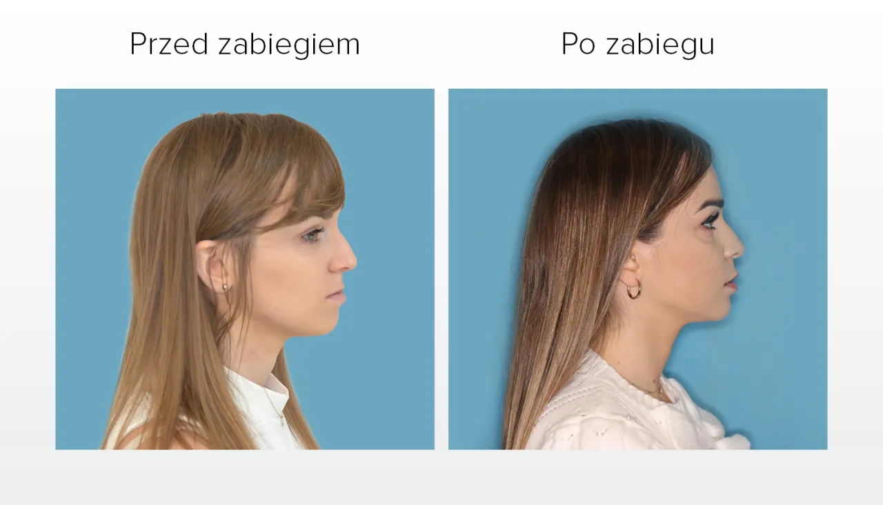 ortodoncja wady zgryzu porównanie