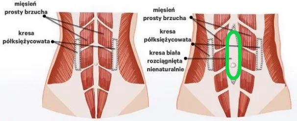 rozejście mięśnia prostego brzucha diagram