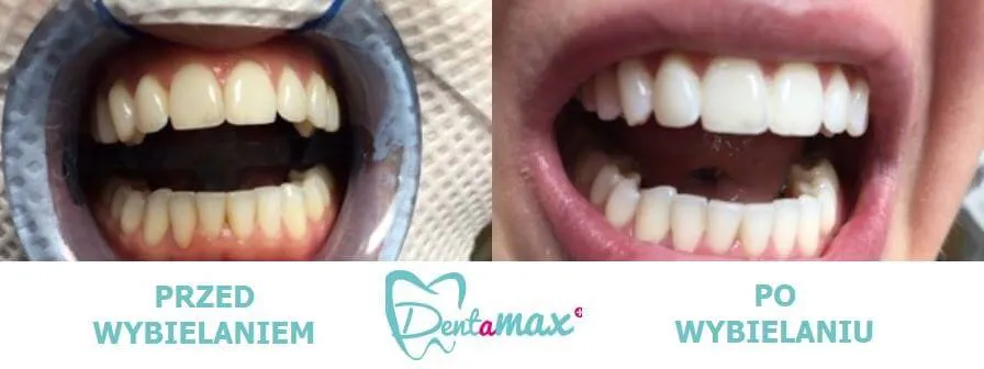 Wybielanie zębów gabinet stomatologiczny