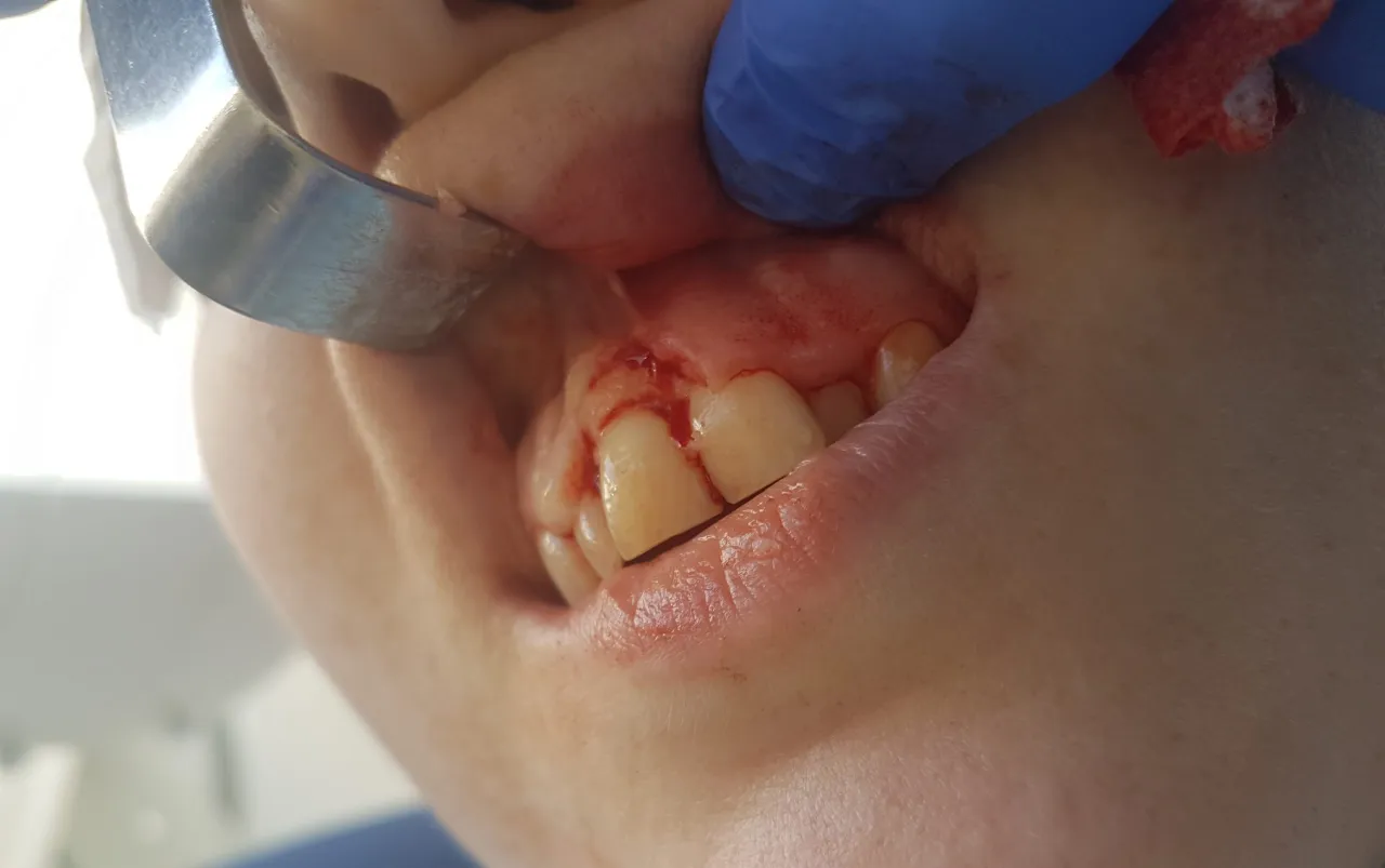 nadziąślak afty liszaj płaski dziąseł zdjęcia