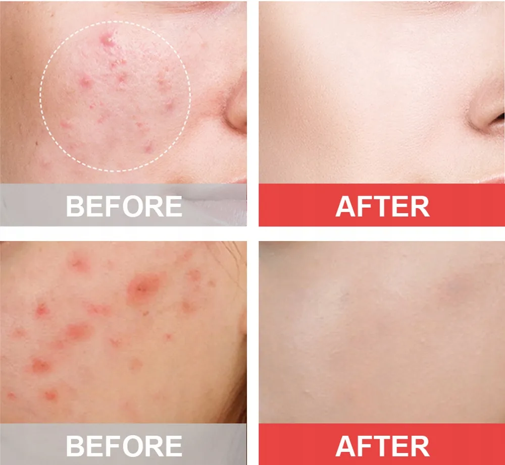 Plasterki hydrokoloidowe na pryszcze przed i po