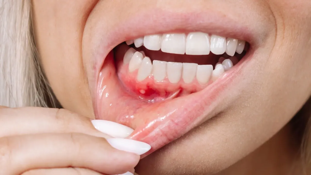 różnice między rakiem dziąseł a zapaleniem dziąseł zdjęcia