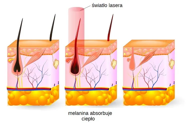 Depilacja laserowa mechanizm działania na melaninę