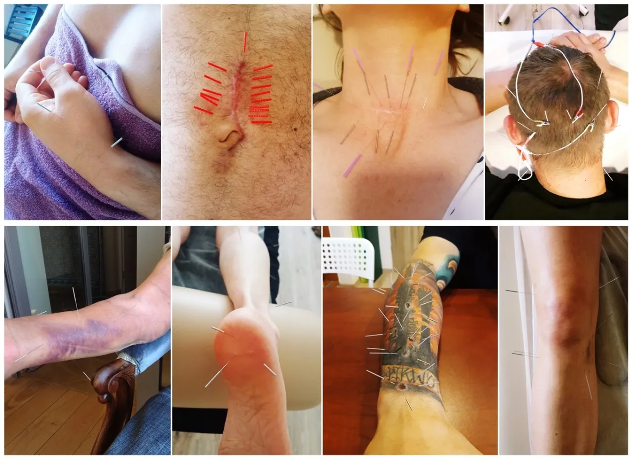 Akupunktura Poznań cennik