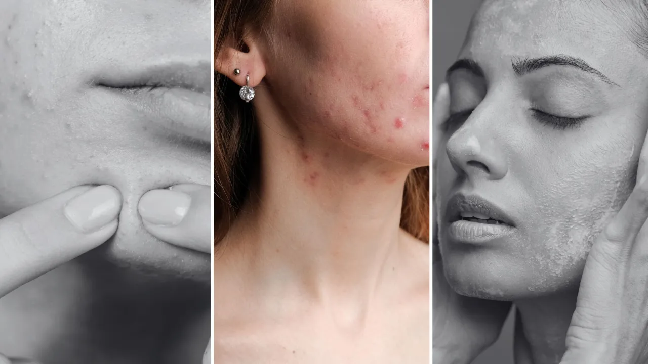 Dermatolog wizyta, kosmetolog zabiegi na trądzik