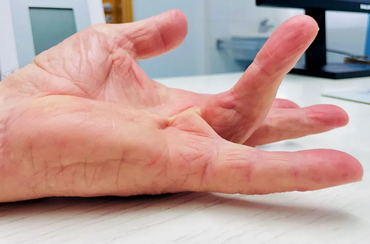 Test stołowy przykurcz Dupuytrena