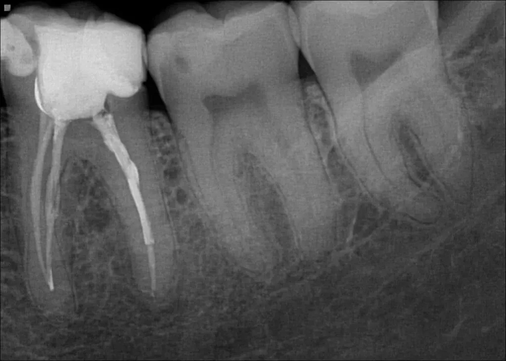 zdjęcie rtg zęba punktowe