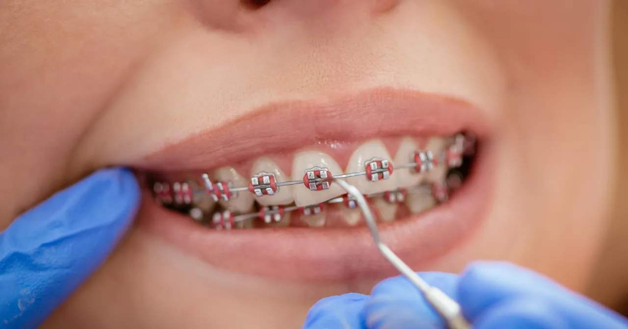 przeciwwskazania do aparatu ortodontycznego