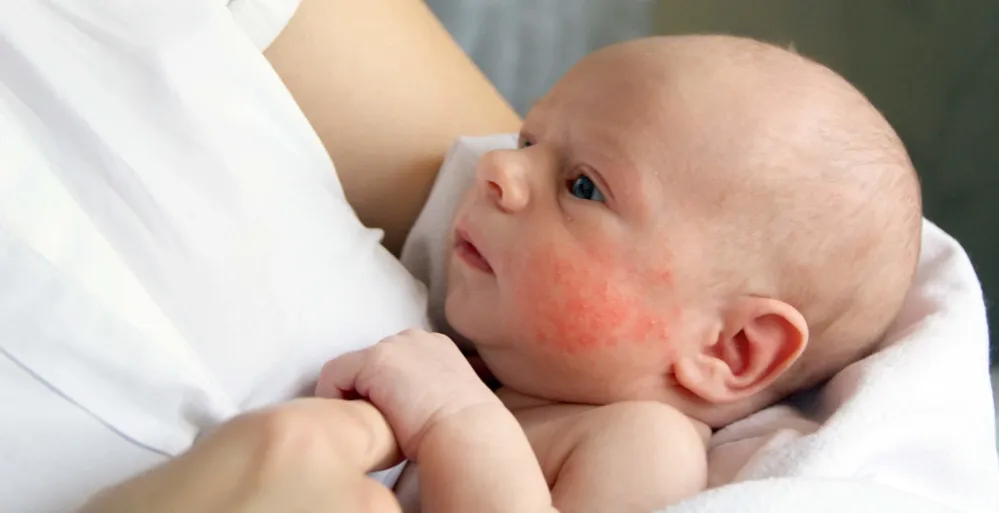 Atopowe zapalenie sk&oacute;ry u niemowląt