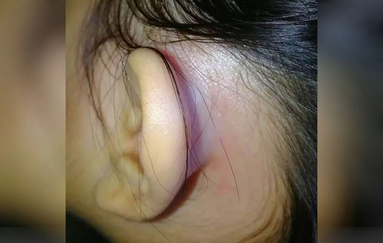 Obrzęk i zaczerwienienie za uchem przy zapaleniu wyrostka sutkowatego