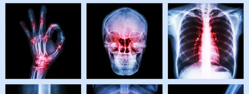 objawy niedoboru witaminy K2 kości serce
