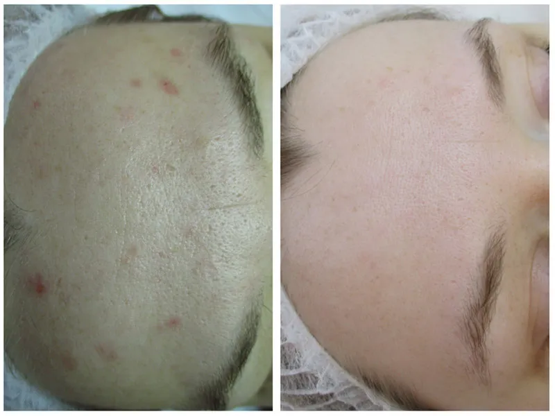 kwas fitowy efekty na sk&oacute;rze przebarwienia trądzik naczynka