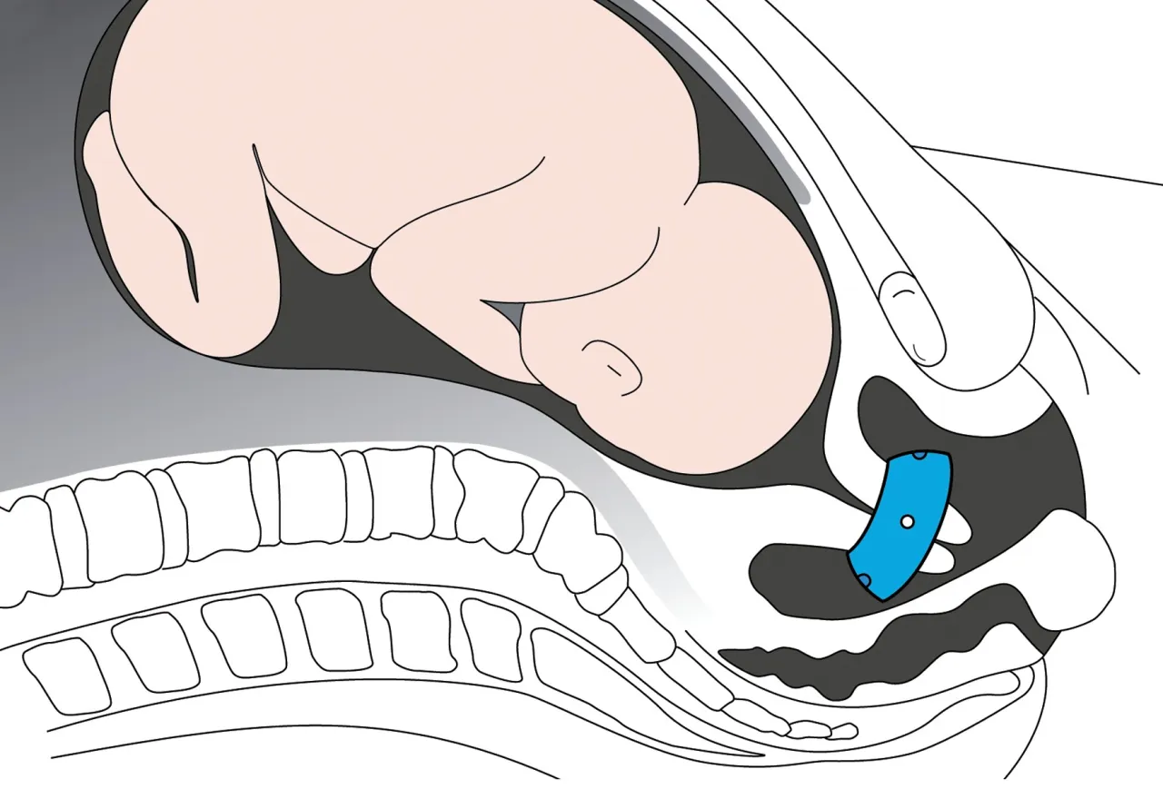 pessar szyjkowy w macicy schemat