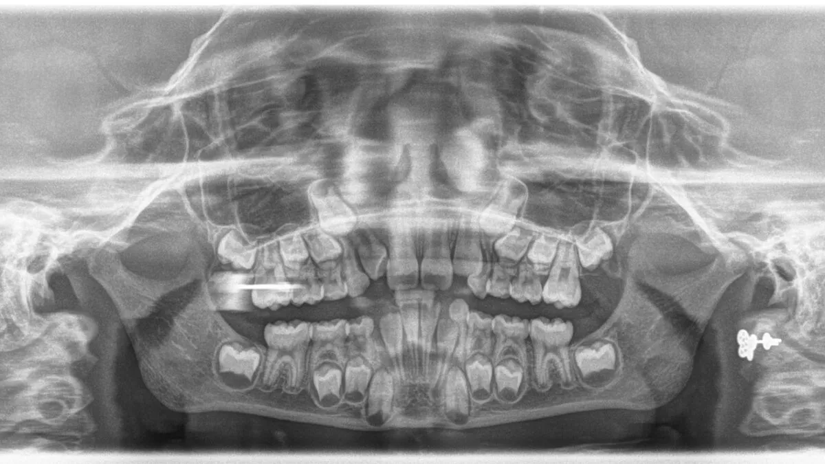 Zdjęcie rentgenowskie zębów anomalie hipodoncja hiperdoncja