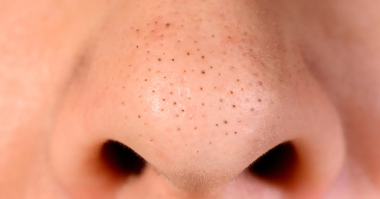 domowe sposoby na pryszcze na nosie