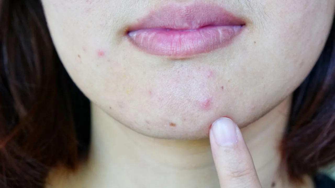 kiedy iść do dermatologa z pryszczami