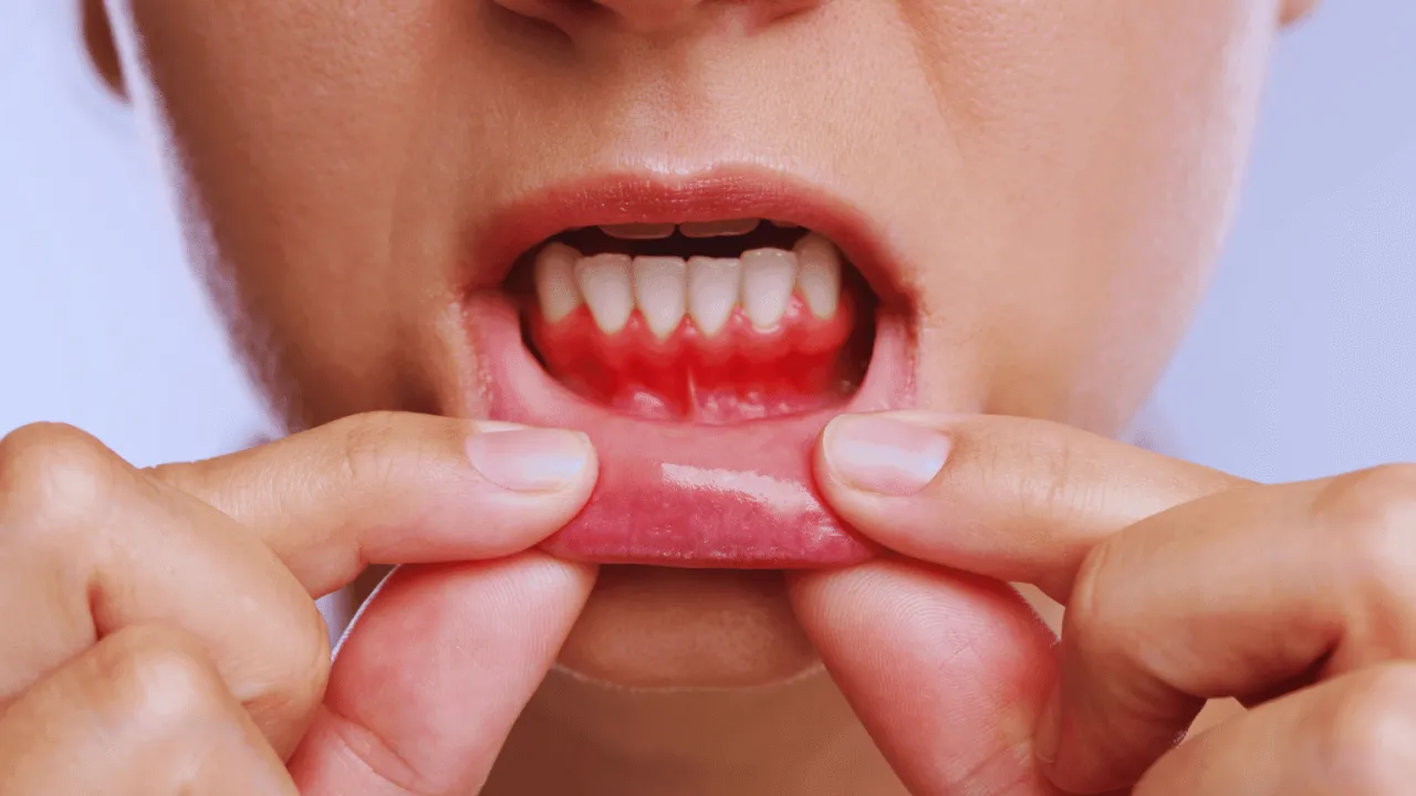 przyczyny ropnia dziąsła grafika