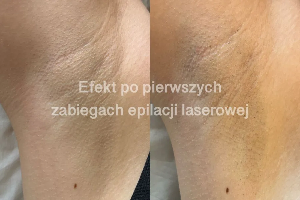 epilacja laserowa efekty typy skóry i włosów