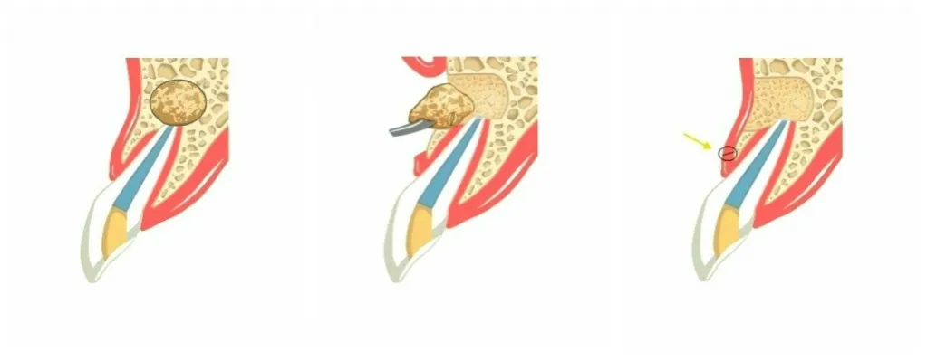 rodzaje torbieli zębopochodnych infografika