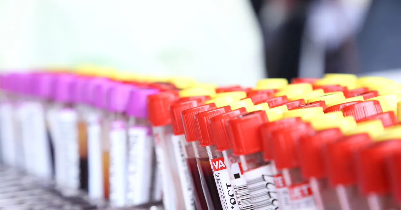 schemat konfliktu serologicznego w ciąży