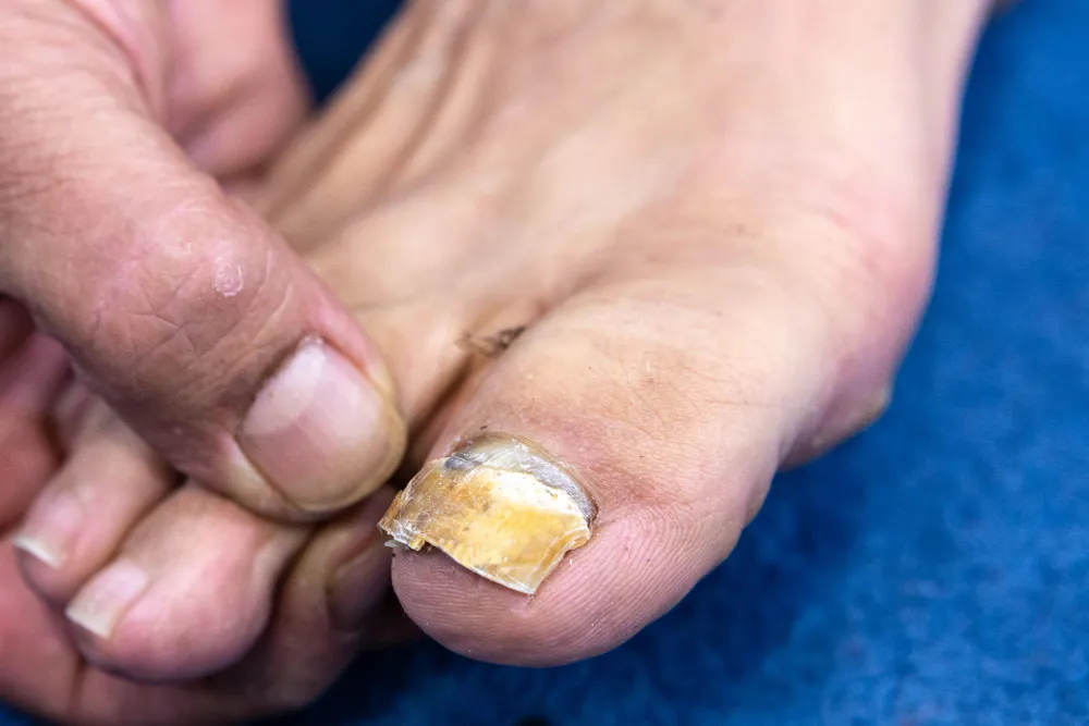 Paznokieć schodzący po urazie i paznokieć z grzybicą por&oacute;wnanie