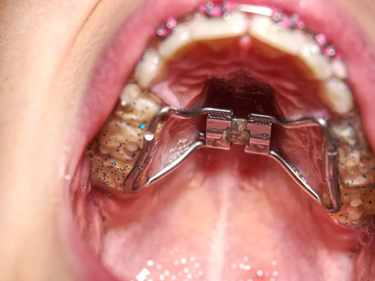 niebezpieczne domowe aparaty na zęby