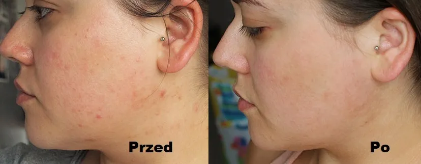 kwas glikolowy efekty przed po