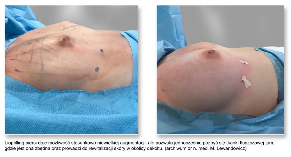 Lipofilling biustu przed i po efekty