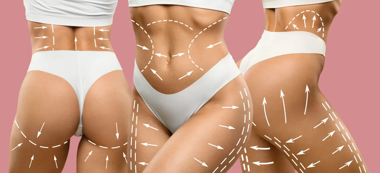 przebieg liposukcji schemat