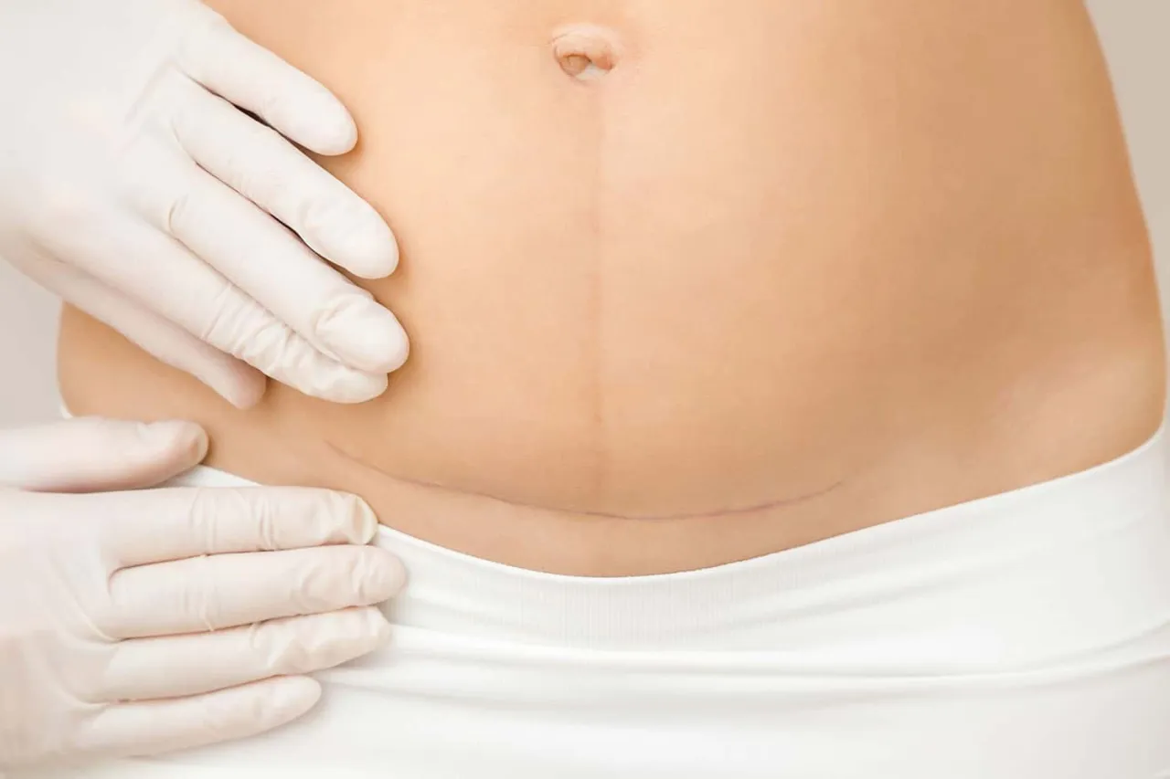 Brzuch po cesarce z widoczną blizną. Kiedy można zacząć ćwiczyć po cesarce? Delikatne badanie blizny.