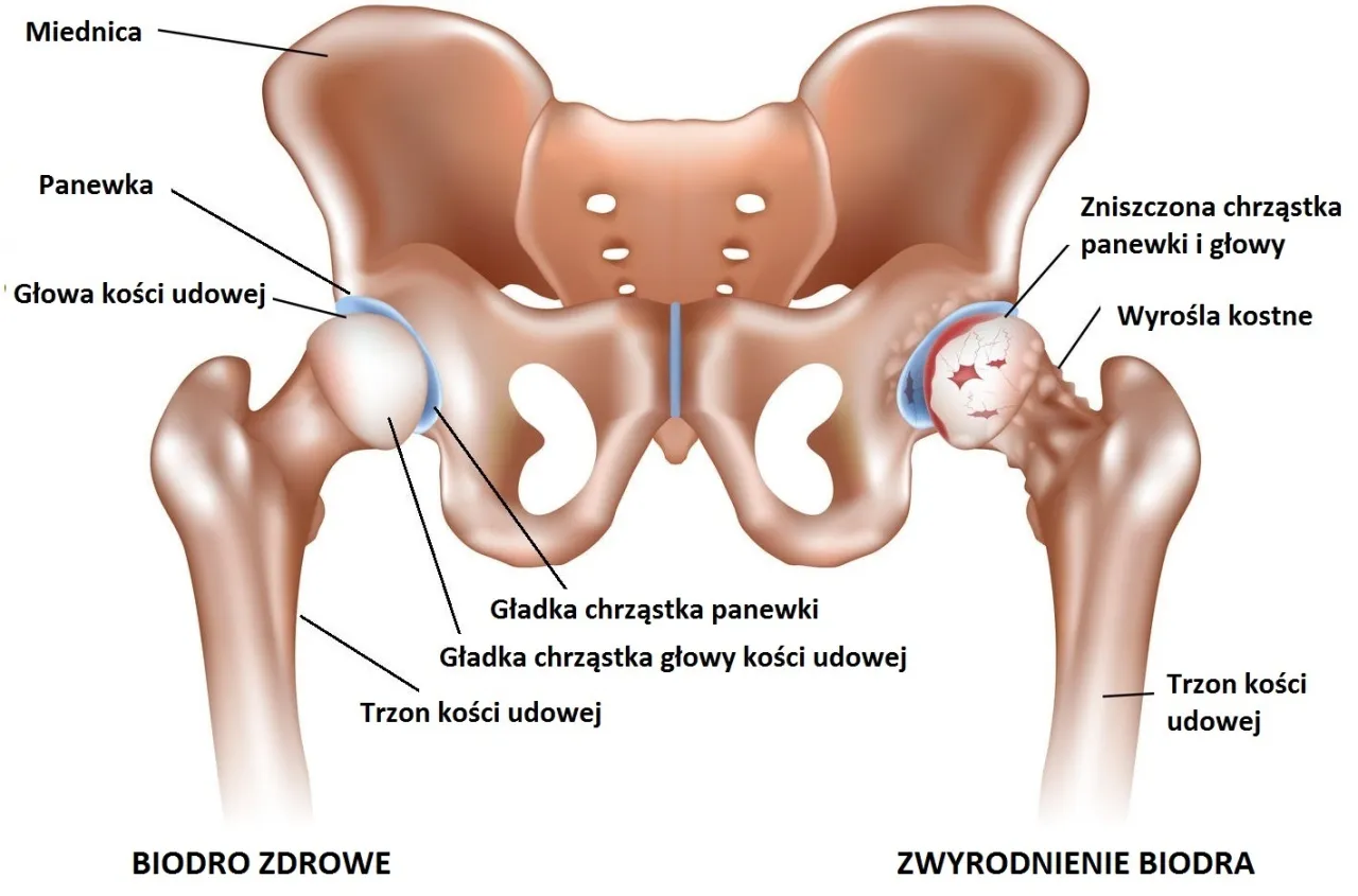 anatomia stawu biodrowego b&oacute;l