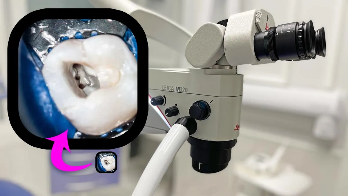 leczenie kanałowe mikroskop