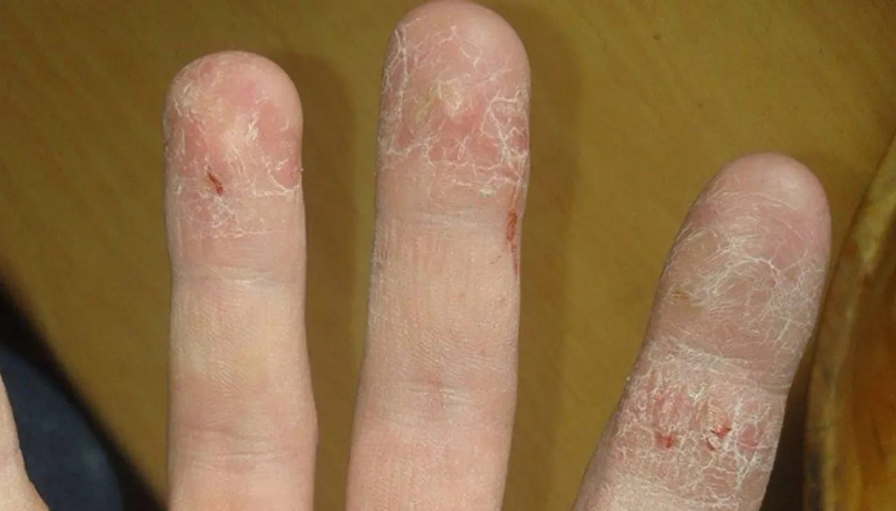 Pękające skórki i zdrowe dłonie porównanie