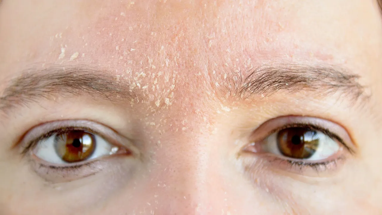 sehr trockene gesichtshaut ursachen