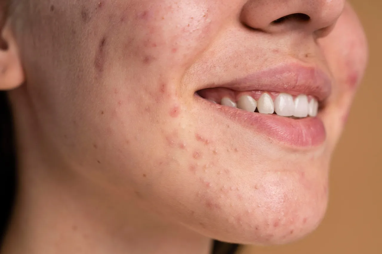 Sk&oacute;ra z widocznymi bliznami po pryszczach. Szukasz informacji, jak pozbyć się blizn po pryszczach domowe sposoby?