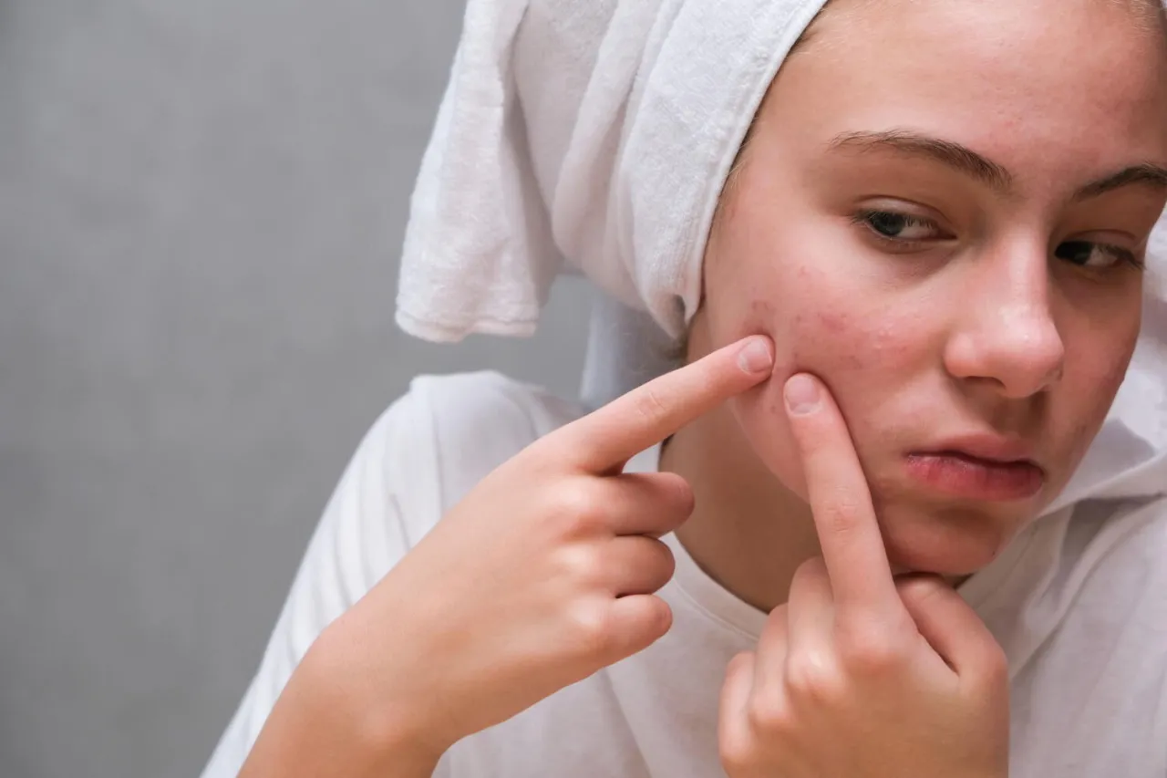 Zdjęcie Co powoduje pryszcze? Poznaj przyczyny i sposoby na ich uniknięcie