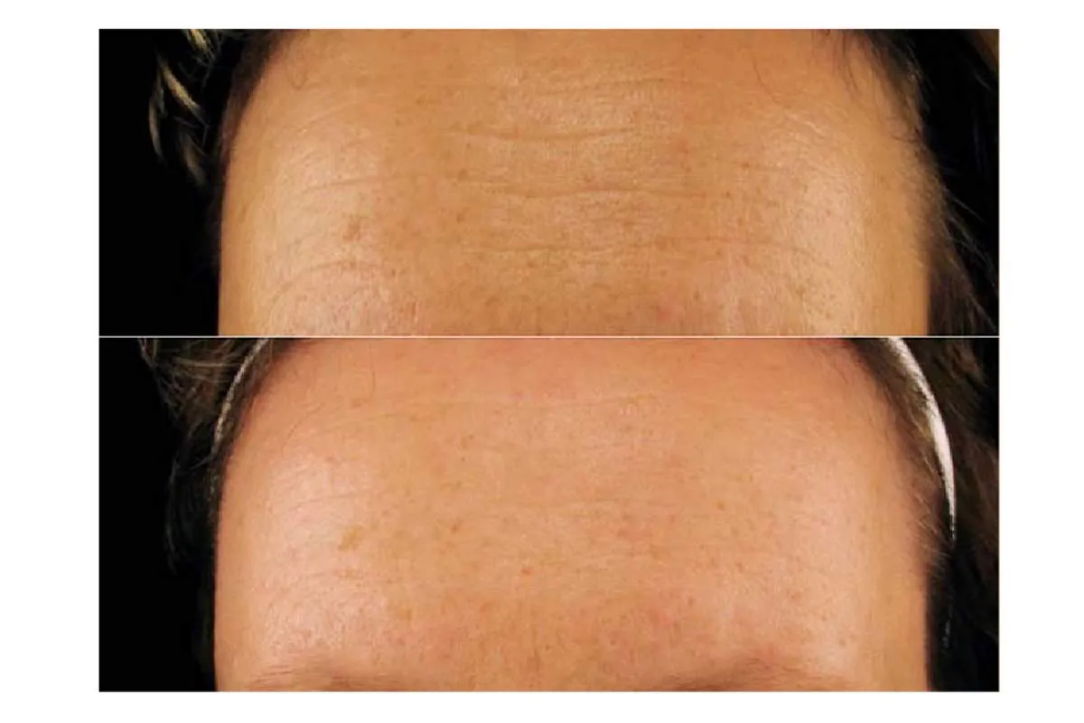 efekty stosowania balsamu kolagenowego przed po