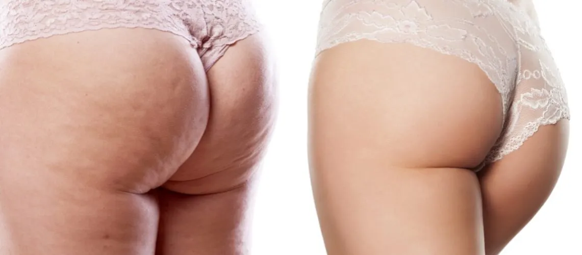 Endermologia przed i po cellulit ujędrnianie