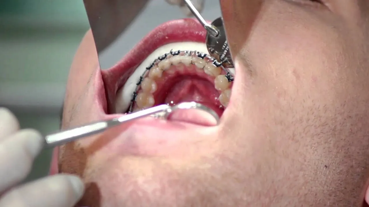 jak włożyć drut do aparatu ortodontycznego pęsetą