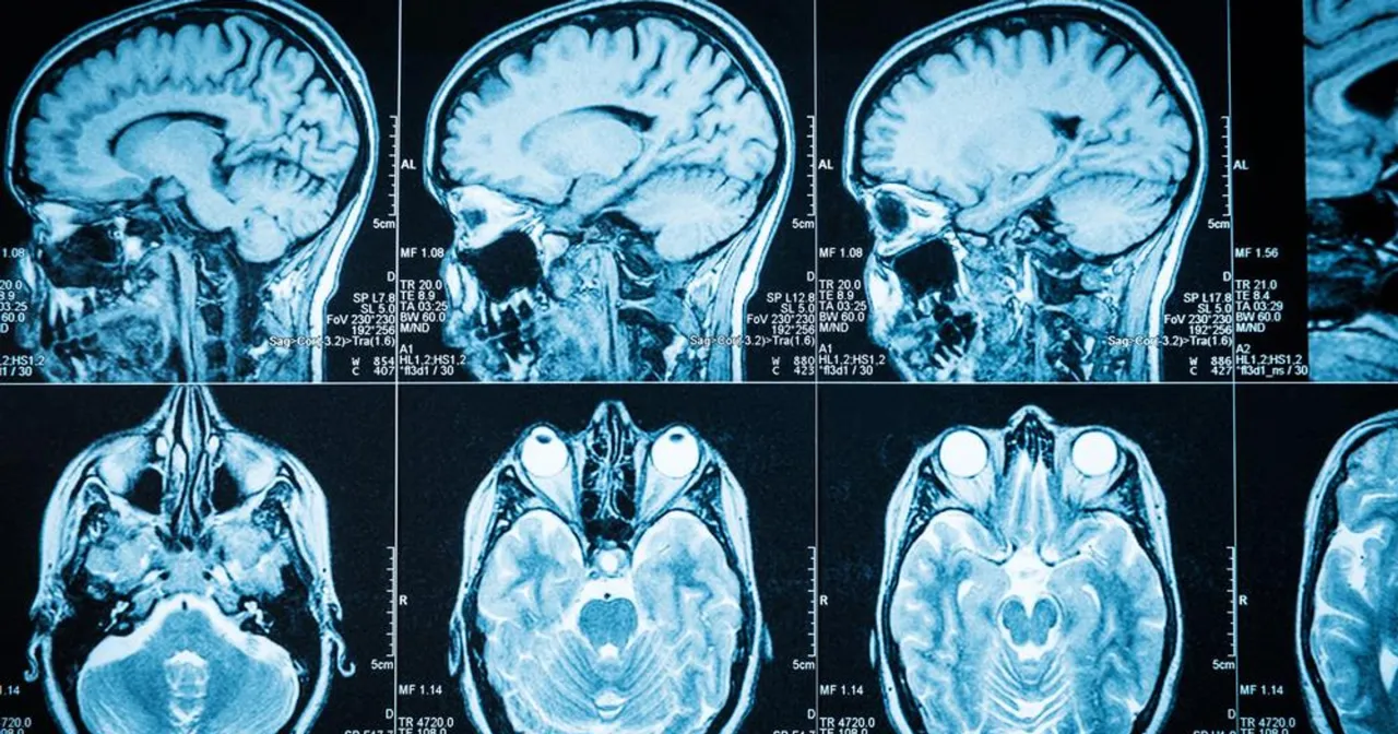 Glejak mózgu - objawy ogólne