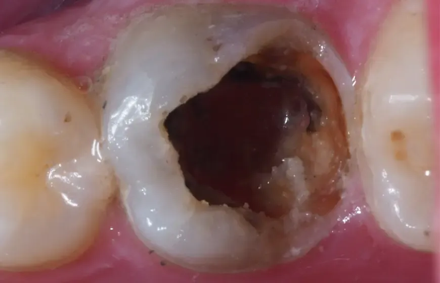 ukruszony ząb dziura w zębie