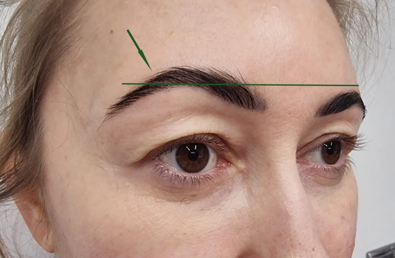 najczęstsze powikłania po botoksie czoła