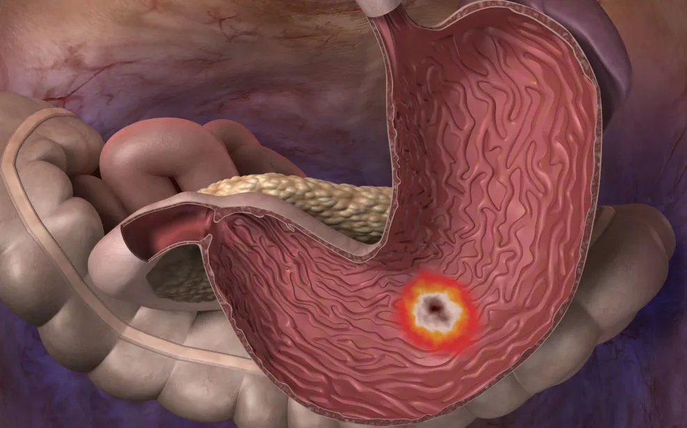 Zdjęcie Skuteczne leki na wrzody dwunastnicy - co musisz wiedzieć?