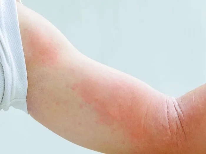 Zdjęcie Czy aloes uczula? Poznaj objawy alergii i jak ich uniknąć